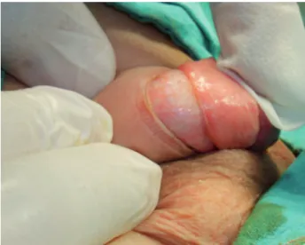 Figure 1 - Image obtained after laser excision.