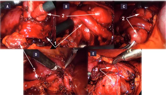 Figure 3 - Cranial relocation of lower pole crossing vessels or &#34;vascular-hitch&#34;