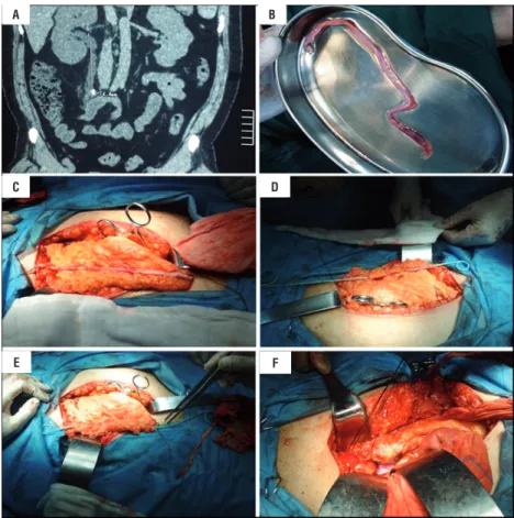 Figure 1 - A) Right hydronephrosis secondary to a stone located in the ureter; B) The avulsed ureter; C) Free vascularized  greater omentum in order to adapt to the avulsed ureter length; D) A single double-J stent tube was placed inside the ureter,  packa