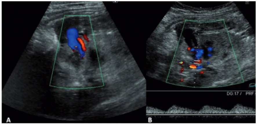 Figure 1 - A-Doppler ultrasound with reverse diastole in interlobular artery and lesion suggestive of pseudoaneurysm at the middle  pole of the kidney