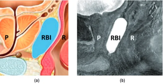 Figure 1 - A schematic illustration (www.bioprotect.co.il) (a) and an MRI image (Balanced Fast Field Echo- sequence) (b)  of a biodegradable rectum balloon implant (RBI) between the anterior rectum wall (R) and the prostate (P), creating space  between the