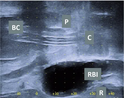 Figure 8 - Sagittal ultrasound image of patient with a rectum balloon implant (RBI) in situ between the prostate (P) and  the rectum (R)