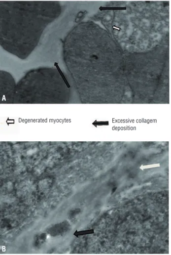 Figure 5 - Nerve hypertrophy (X-50220).