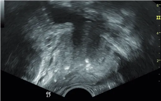 Figure 2 - Transrectal ultrasound in longitudinal  section of prostate shows mild calcifications with 1 or multiple small foci  without coarse shadow.