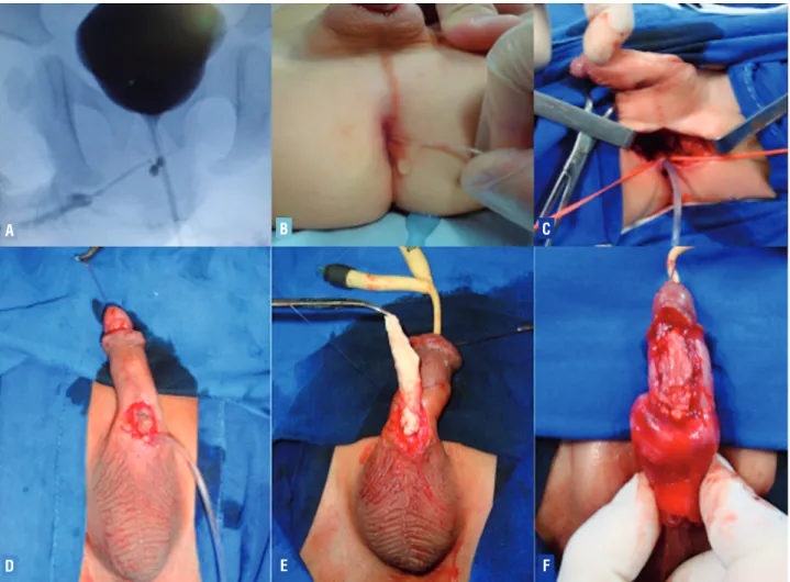 Figure 1- A) Voiding cystourethrogram revealed urethral duplication with a narrow cal-iber dorsal penile orthotopic urethra  and the ventral urethra meatus opening in the rec-tum (type IIA urethral duplication); B) Catheterization of the ventral urethra  b
