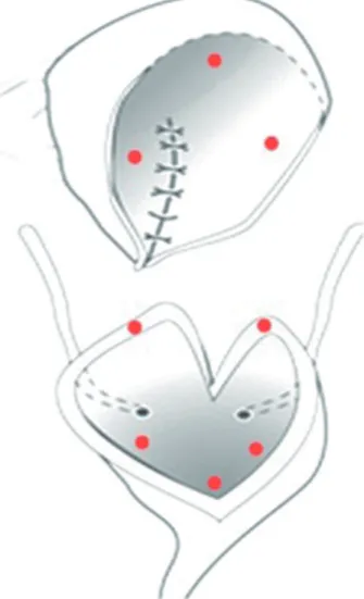 Figure 1 - Planned sites for biopsies (triangular manner).