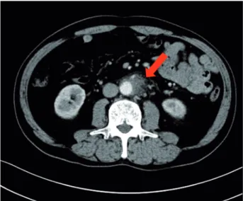 Figure 2 - A) Enhanced computed tomography revealed an  exponential increase of the low density area.