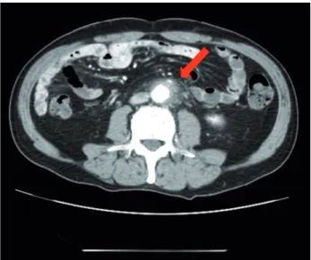 Figure 3 - A) The size of the retroperitoneal soft tissue mass  decreased on day 19 post-admission.