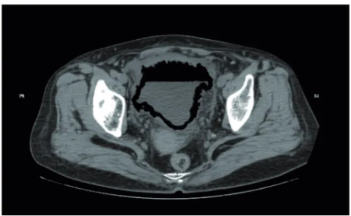 Figure 2 - A prominent air-fluid level within the bladder on  computed tomography.