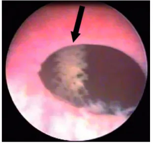 Figure 4a - Pelvic CT scan shows calcified sling tape (arrow)  eroding the bladder wall at the left side 2 years after a  retropubic SSS.