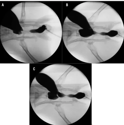 Figure 1 - Urethral stricture in groups on retrograde uretrography on postoperative 28 th  day.