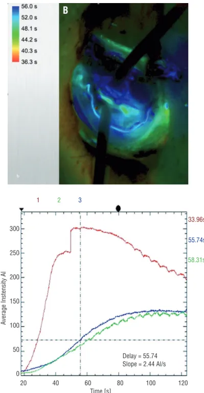 Figure 2 - Built-in fluorescence modules of the operating microscope provided analysis of the vascular dynamics