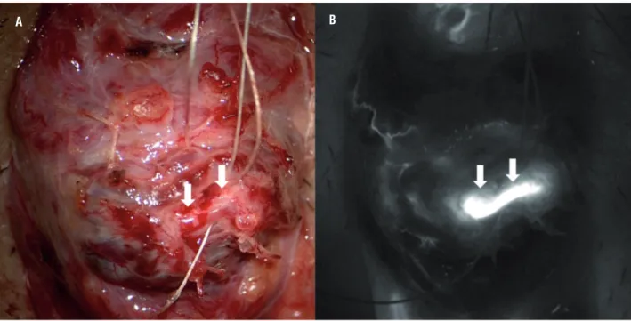 Figure 3 - Intraoperative indocyanine green angiography may facilitate early identification of testicular artery