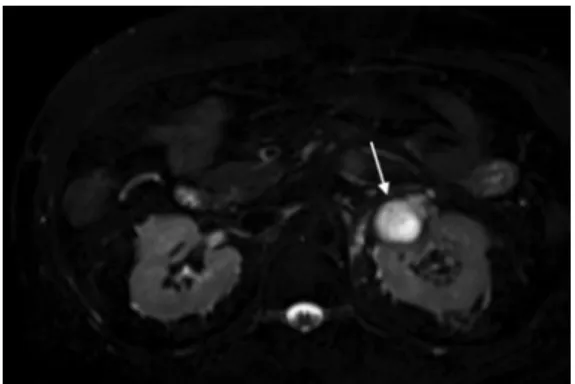 Figure 3 - Coronal T1 pre-contrast imaging – the lesion is  hypointense to adjacent renal parenchyma (arrow).