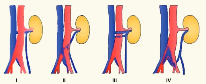 Figure 1- Types of left renal vein anomalies: Type I Retroaortic Left renal vein (RLRV) join the IVC in the orthotopic  position, Type II RLRV join the IVC at level L4-5, Type III - circumaortic left renal vein, Type IV renal vein joins the left  common il
