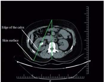 Figure 1- Example of an axial image from a  CT scan, demonstrating the way 'Skin to calyx  distance'calculated.