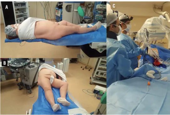 Figure 1 - A) Lateral view of the patient in complete supine position; B) Frontal view of the patient in complete supine  position; C) Surgical team at the right side of patient performing flexible ureteroscopy and laser lithotripsy.