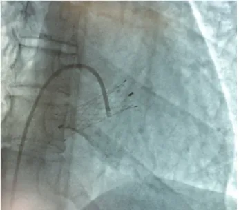 Figure 1 - Atrial migration of a venous stent rendered this  35-year-old woman with a severe valvar insufficiency.