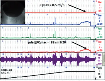 Figure 3 - Sample VUDS of patient with BOO and normal detrusor function.