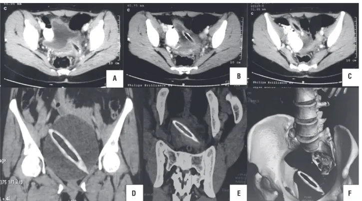 Figure 1 - Computed tomography scan [axial section (A-C) and coronal section (D-F)] showing hypodense linear foreign body  (10.2 x 1.2cm) piercing the anterior vaginal wall and left posterior bladder wall with majority of its part lying inside the  bladder