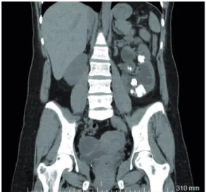 Figure 1 - Computed tomography scan with multiple calculus  in left kidney.