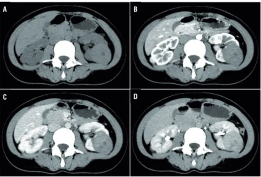 Figure 1 - Enhanced computed tomography scan (CT) demonstrated a 4.5×4.0×4.5cm neoplasm in the middle and dorsal part  of left kidney (CT unit: 45)