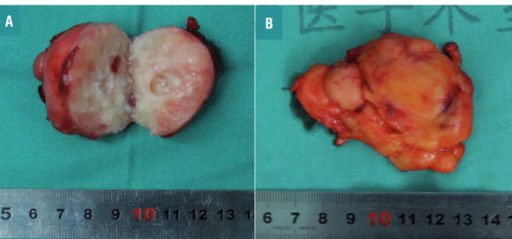 Figure 2 - Gross pathologic features of the resected specimen. The cut section indicated a red-white cystic solid tumor mass  measuring 5×4cm (A)