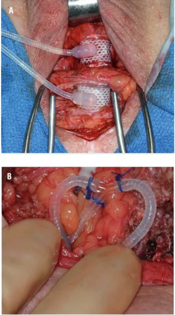 Figure 1 - Tandem urethral cuff placement (a), connection of  tandem urethral cuff to in-situ system (b).