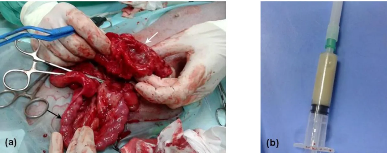 Figura  1  –  Piómetra  por  E.  coli  em  cadela.  (a)  Útero  distendido  e  de  parede  espessada  (seta  preta),  aderências  peritoneais  devido  a  rutura  uterina  (seta  branca);  (b)  Líquido  purulento  uterino  colhido  para  citologia e cultura