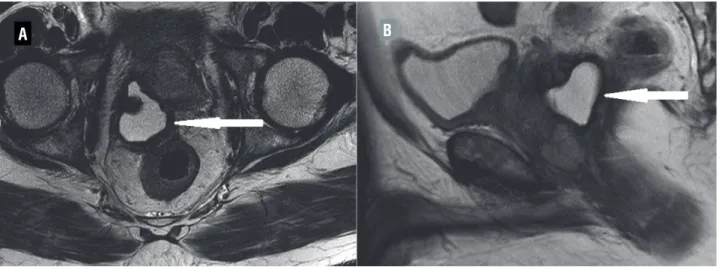 Figure 2 - (A and B): Reduction in size of cyst (arrow) after androgen deprivation therapy.
