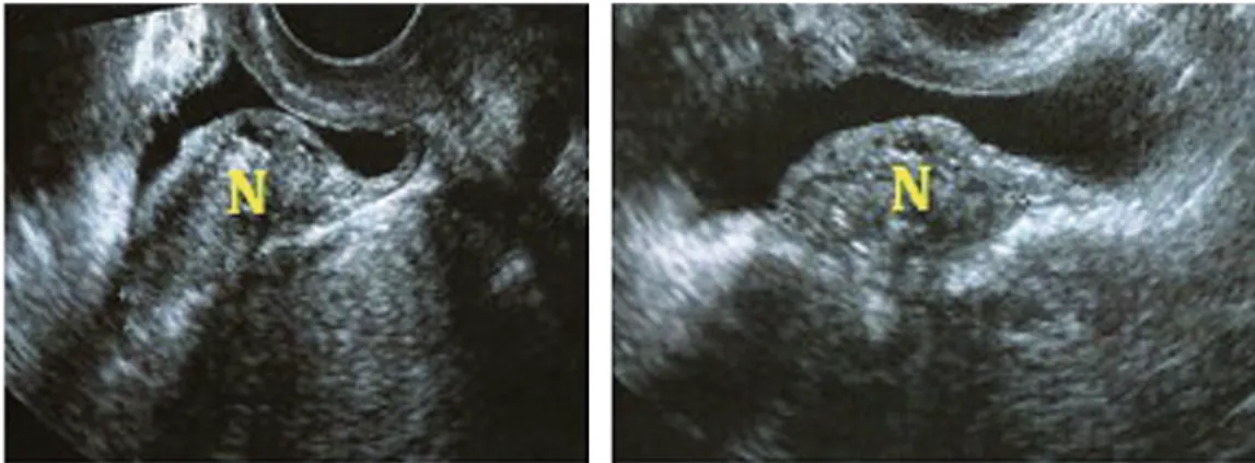 Figure 1C - MRI of the pelvis depicting hypo-signal on T2 (lesion is highlighted).