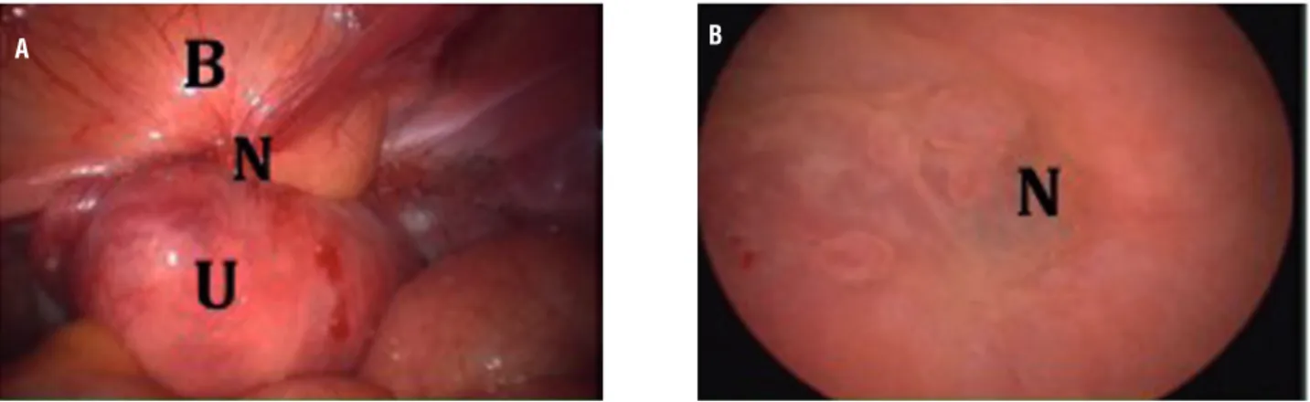 Figure 1D - A - Endometriosis in laparoscopic view, B - Endometriosis in cistoscopic view.