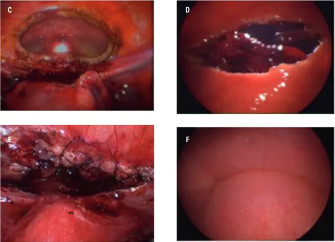 Figure 1E - C e E - Endometriosis ressection and suture in laparoscopic view D e F - Endometriosis ressection and suture in  cistoscopic view.