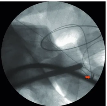 Figure 2 - Cystoscopic view of holding broken blade with  Double J removal forceps.