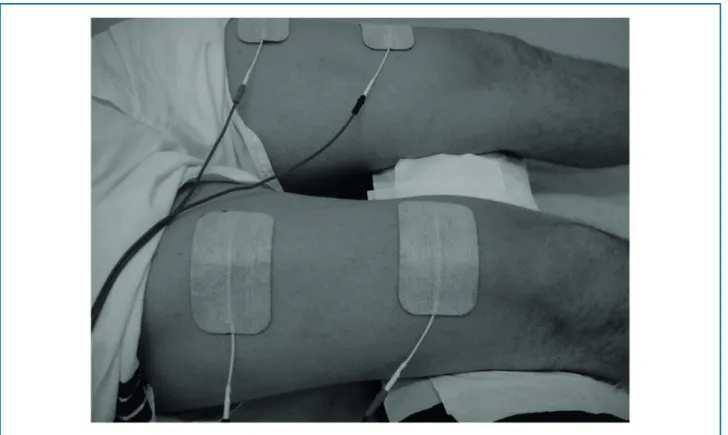 Figure 1 – Placement of adhesive electrodes over the quadriceps femoral muscle. A single set of double adhesives was used as a simple way of applying  neuromuscular electrical stimulation.