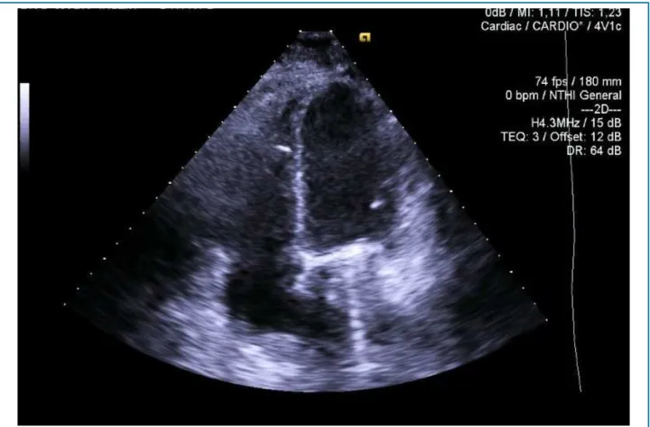 Figure 1 – Transthoracic echocardiography performed at admission disclosed global hypokinesis of the left and right ventricles, with severe decrease in  biventricular systolic function.