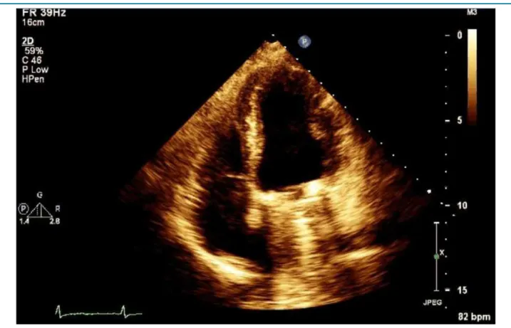 Figure 2 – Transthoracic echocardiogram performed on discharge showing moderate LVSF decrease with ejection fraction of 40% and preserved RVSF.