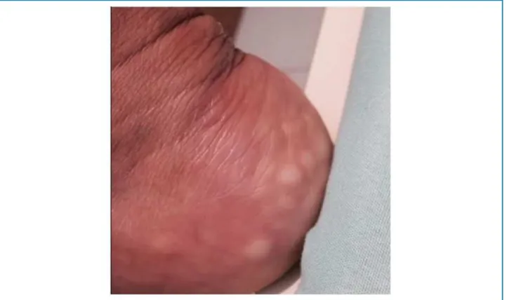 Figure 1 – Xanthoma in the calcaneus.