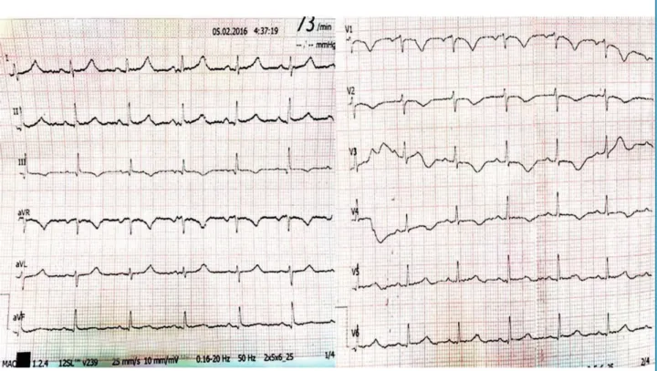 Figure 1 – ECG showing S1Q3T3 pattern and RV strain.