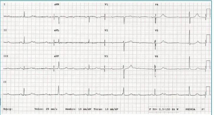 Figura 2 – Eletrocardiograma com inversão de onda T nas derivações DII, DIII e aVF e V3 a V6 no seguimento após implante de marca-passoFigura 1 – Eletrocardiograma mostrando bloqueio atrioventricular avançado na admissão hospitalar