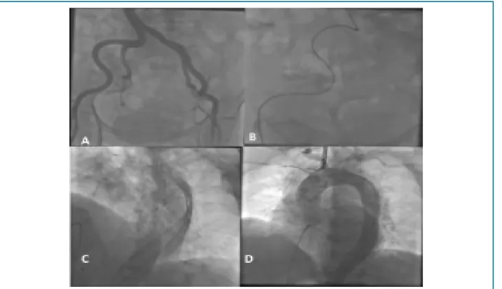 Figure 1 – Angiographic images showing severe tortuous iliac artery (A. B), retrograd aortic dissection (C), and aortography via right femoral               artery (D).