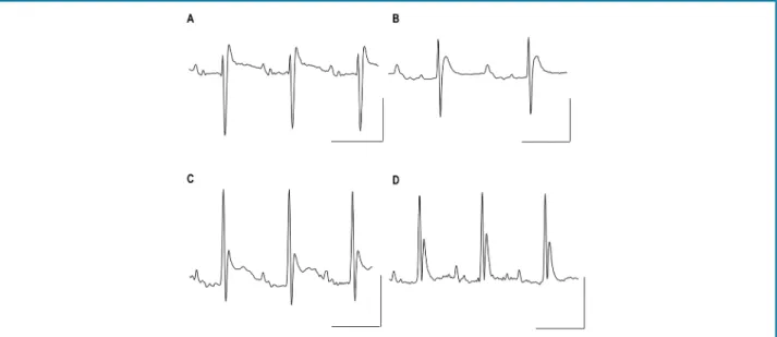 Tabela 3 – Análise histopatológica em amostras do ventrículo direito e do ápice cardíaco de camundongos com  cardiomiopatia chagástica aguda e insuficiência cardíaca tratados ou não com nifurtimox e dipiridamol