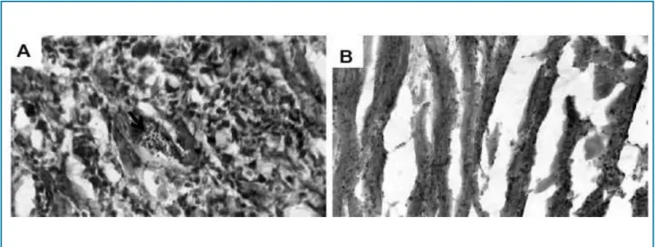 Figura 4 – Características histopatológicas do tecido cardíaco de camundongos com doença de Chagas aguda, tratados ou não com nifurtimox e  dipiridamol