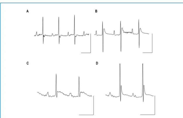 Table 2 – Electrocardiographic qualitative parameters recorded in mice with acute chagas cardiomyopathy with heart  failure before and after starting the therapeutic protocol