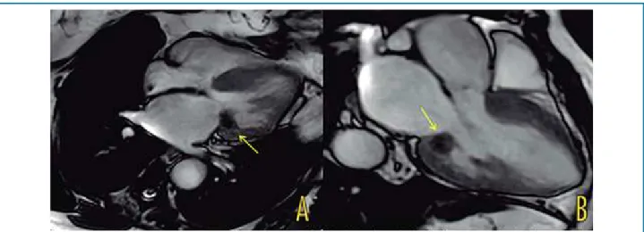 Figura 1 – Ressonância magnética de coração. A) Corte apical 4 câmaras; B) Corte apical 3 câmaras.