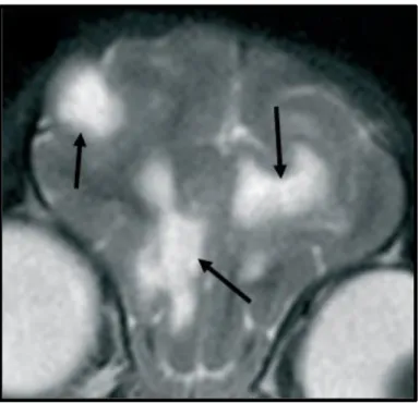 Figura 13. RM de um cão diagnosticado com leucoencefalite necrosante, em T2 num  corte transversal ao nível dos lobos fronto-parietais