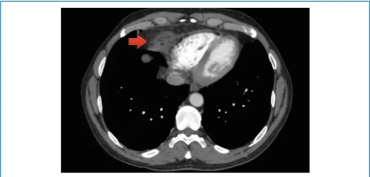 Figure 3 – Axial section of chest computed angiotomography.
