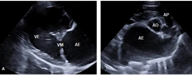 Figura 1. Imagens ecocardiográficas de paciente canino diagnosticado com DDMVM. A –  Dilatação das cavidades cardíacas esquerdas, com válvula mitral espessada e prolapsada; B – 