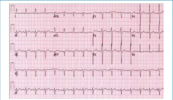 Figure 1 – ECG: tachycardic sinus rhythm, PR 0.16 seconds, heart rate 150 bpm; Superior divisional block.