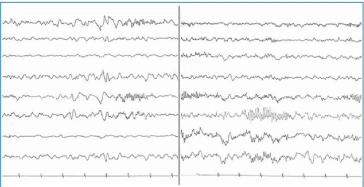 Figure 2 – EEG: positive spicules (14 and 16 per second).